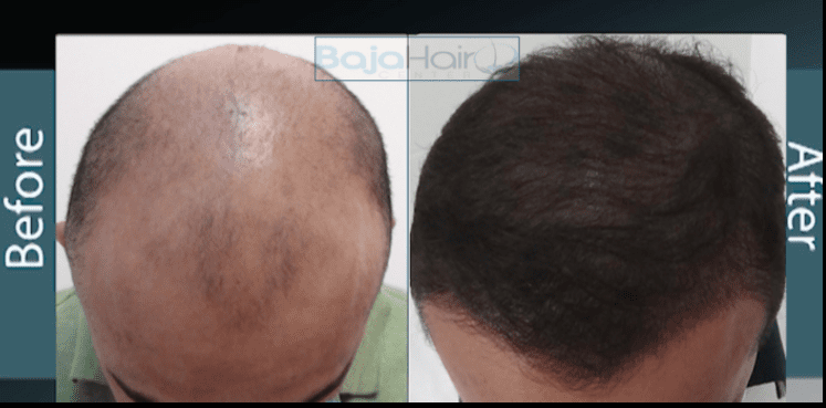 Before & After Results - Baja Medi Spa